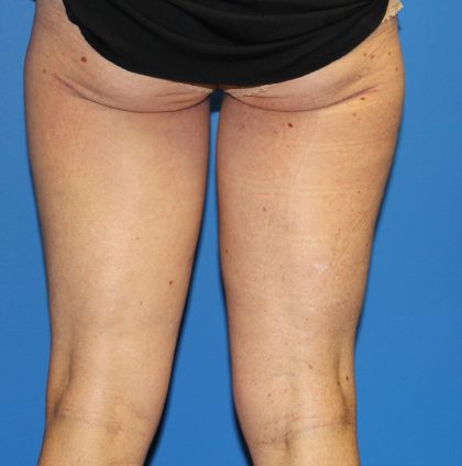 Thigh Lift Before & After Patient #4180
