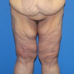 Thigh Lift Before & After Patient #4185