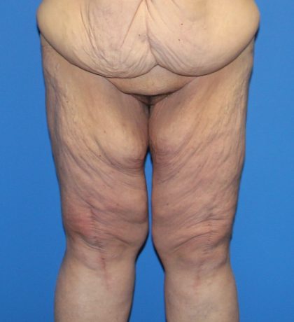 Thigh Lift Before & After Patient #4185