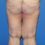 Thigh Lift Before & After Patient #4185