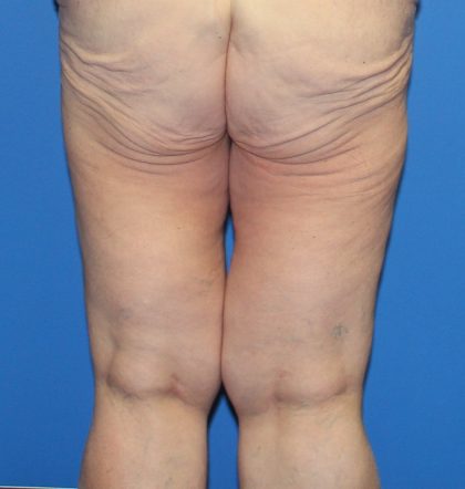 Thigh Lift Before & After Patient #4185