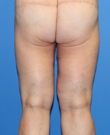 Thigh Lift Before & After Patient #4185