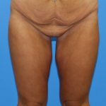 Thigh Lift Before & After Patient #4190