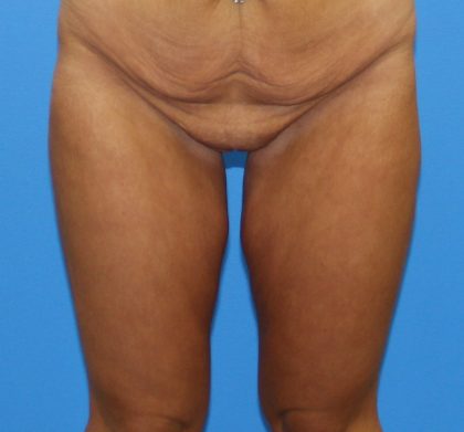 Thigh Lift Before & After Patient #4190