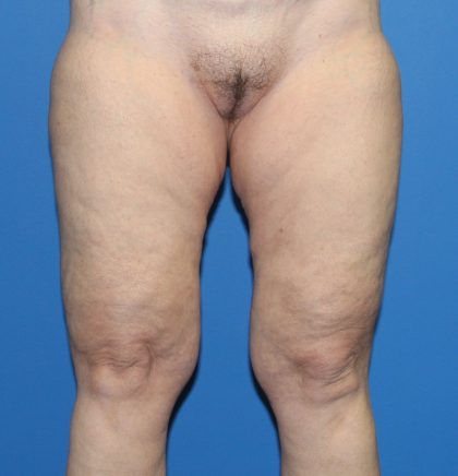 Thigh Lift Before & After Patient #4193