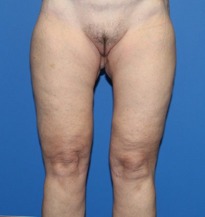 Thigh Lift Before & After Patient #4193