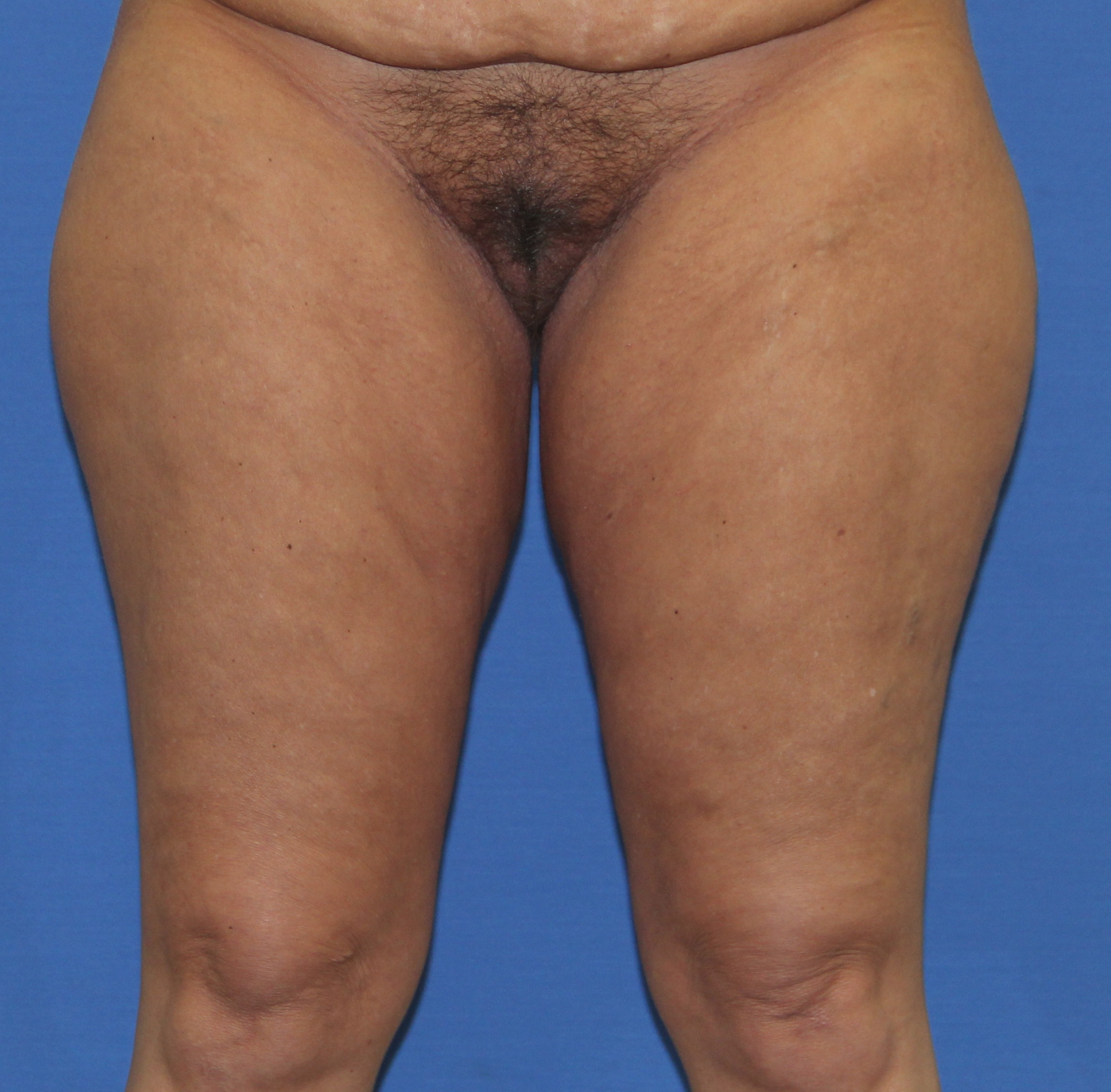Thigh Lift Before & After Patient #4199