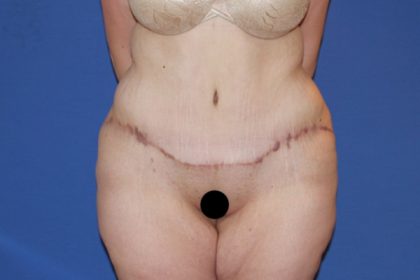 Extended Tummy Tuck Before & After Patient #3246