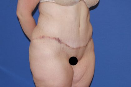 Extended Tummy Tuck Before & After Patient #3246