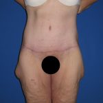 Tummy Tuck Before & After Patient #3373