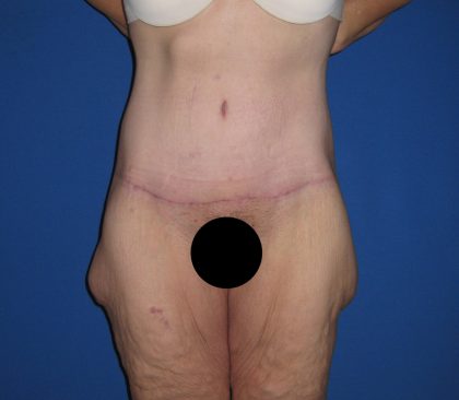Tummy Tuck Before & After Patient #3373