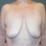 Breast Lift Before & After Patient #3430