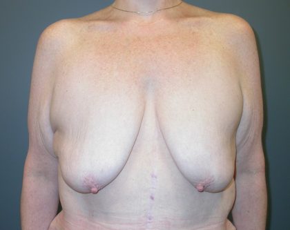 Breast Lift Before & After Patient #3430