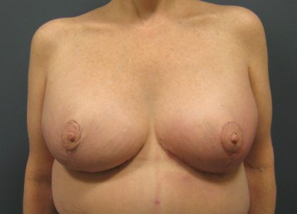 Breast Lift Before & After Patient #3430