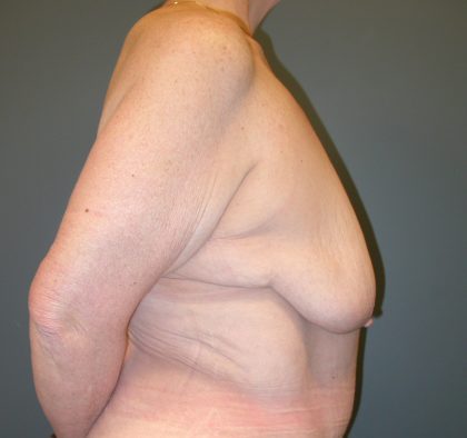 Breast Lift Before & After Patient #3430