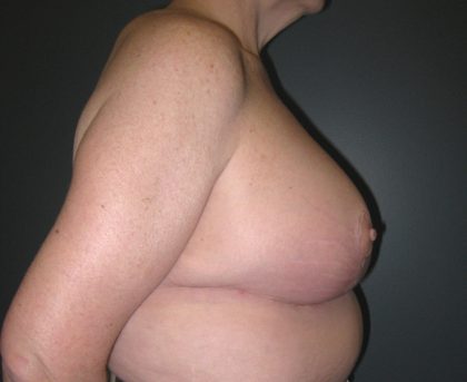 Breast Lift Before & After Patient #3430