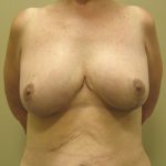 Breast Lift Before & After Patient #3422