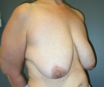 Breast Lift Before & After Patient #3422