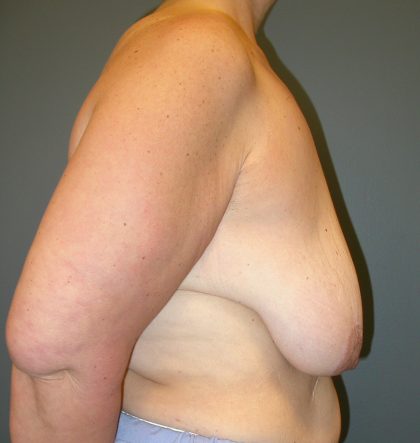 Breast Lift Before & After Patient #3422