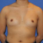 Breast Augmentation Before & After Patient #2658