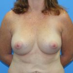 Breast Augmentation Before & After Patient #2707
