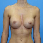 Breast Augmentation Before & After Patient #2714