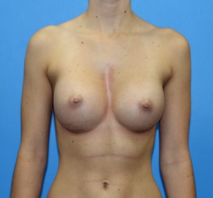 Breast Augmentation Before & After Patient #2714