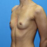Breast Augmentation Before & After Patient #2714