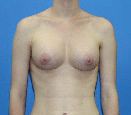 Breast Augmentation Before & After Patient #2700
