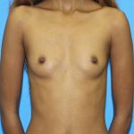 Breast Augmentation Before & After Patient #2679
