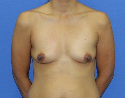 Breast Augmentation Before & After Patient #2686