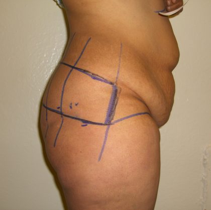 Tummy Tuck Before & After Patient #3380