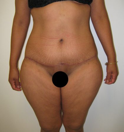 Tummy Tuck Before & After Patient #3380