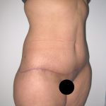 Tummy Tuck Before & After Patient #3380