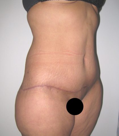 Tummy Tuck Before & After Patient #3380