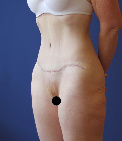 Tummy Tuck Before & After Patient #3172