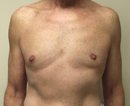 Tummy Tuck Before & After Patient #2870