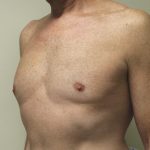 Tummy Tuck Before & After Patient #2870