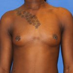 Breast Augmentation Before & After Patient #2742