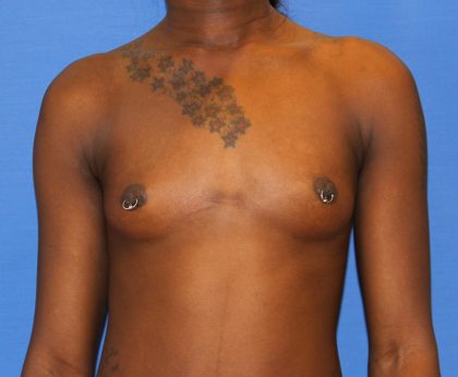 Breast Augmentation Before & After Patient #2742