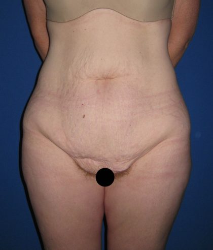 Tummy Tuck Before & After Patient #3172