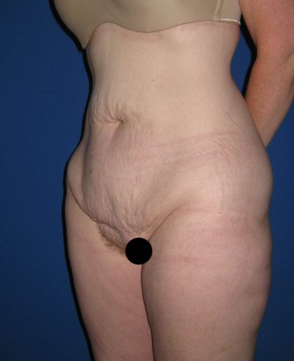 Tummy Tuck Before & After Patient #3172