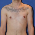 Gynecomastia Before & After Patient #2878