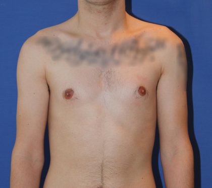 Gynecomastia Before & After Patient #2878