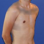 Gynecomastia Before & After Patient #2878