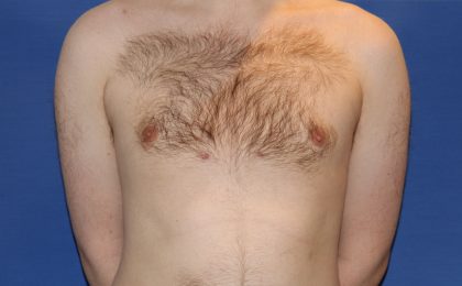 Gynecomastia Before & After Patient #2885