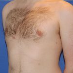 Gynecomastia Before & After Patient #2885