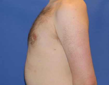 Gynecomastia Before & After Patient #2885