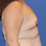 Breast Augmentation Before & After Patient #2763