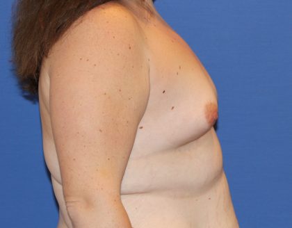 Breast Augmentation Before & After Patient #2763